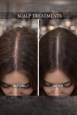 Scalp Treatments
